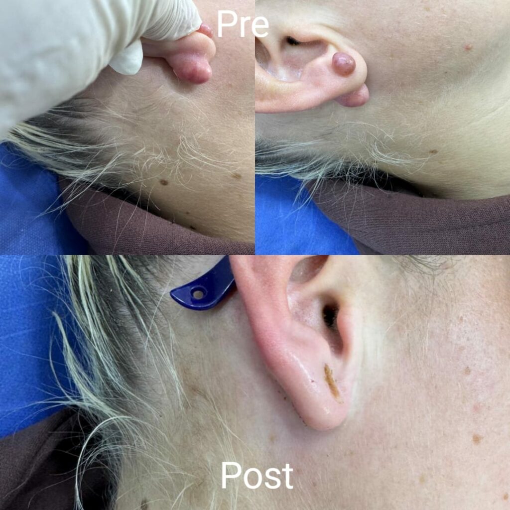 Laser ear lesions removal